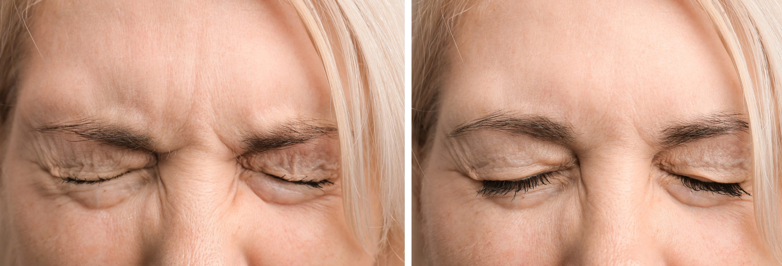 Image of a woman before and after treatments of Botox Injection by Med Spa Solana Beach Arc Medical Aesthetics.